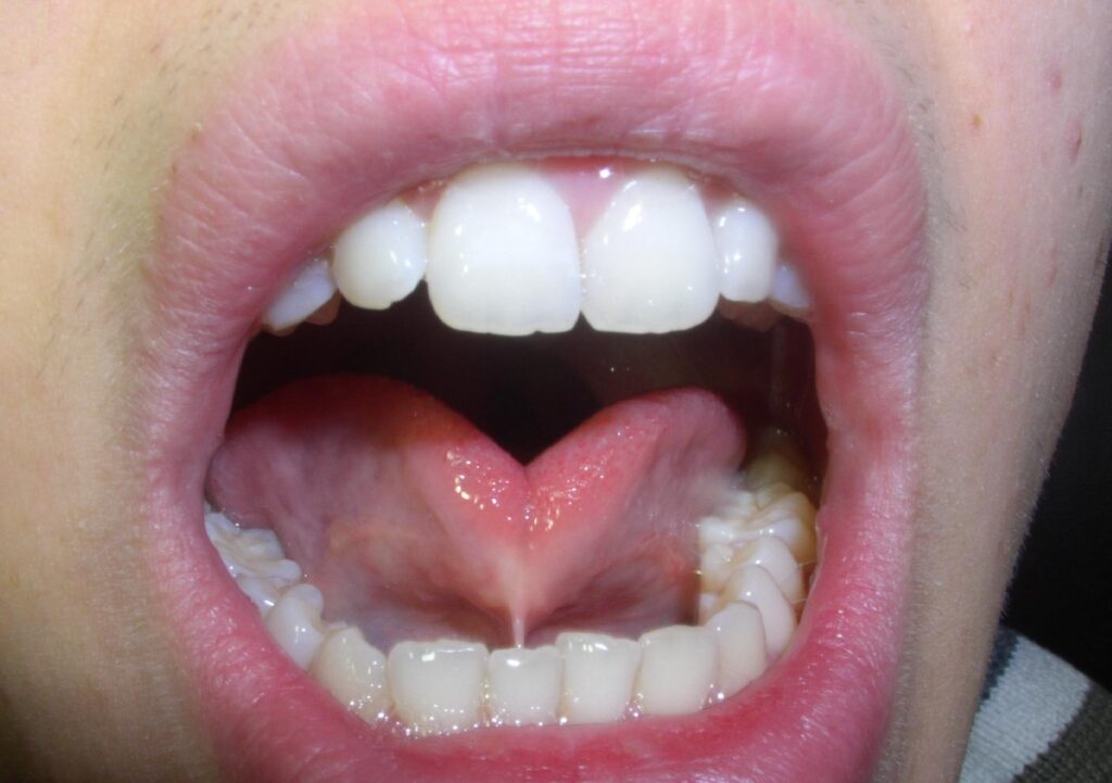 Anquiloglosia