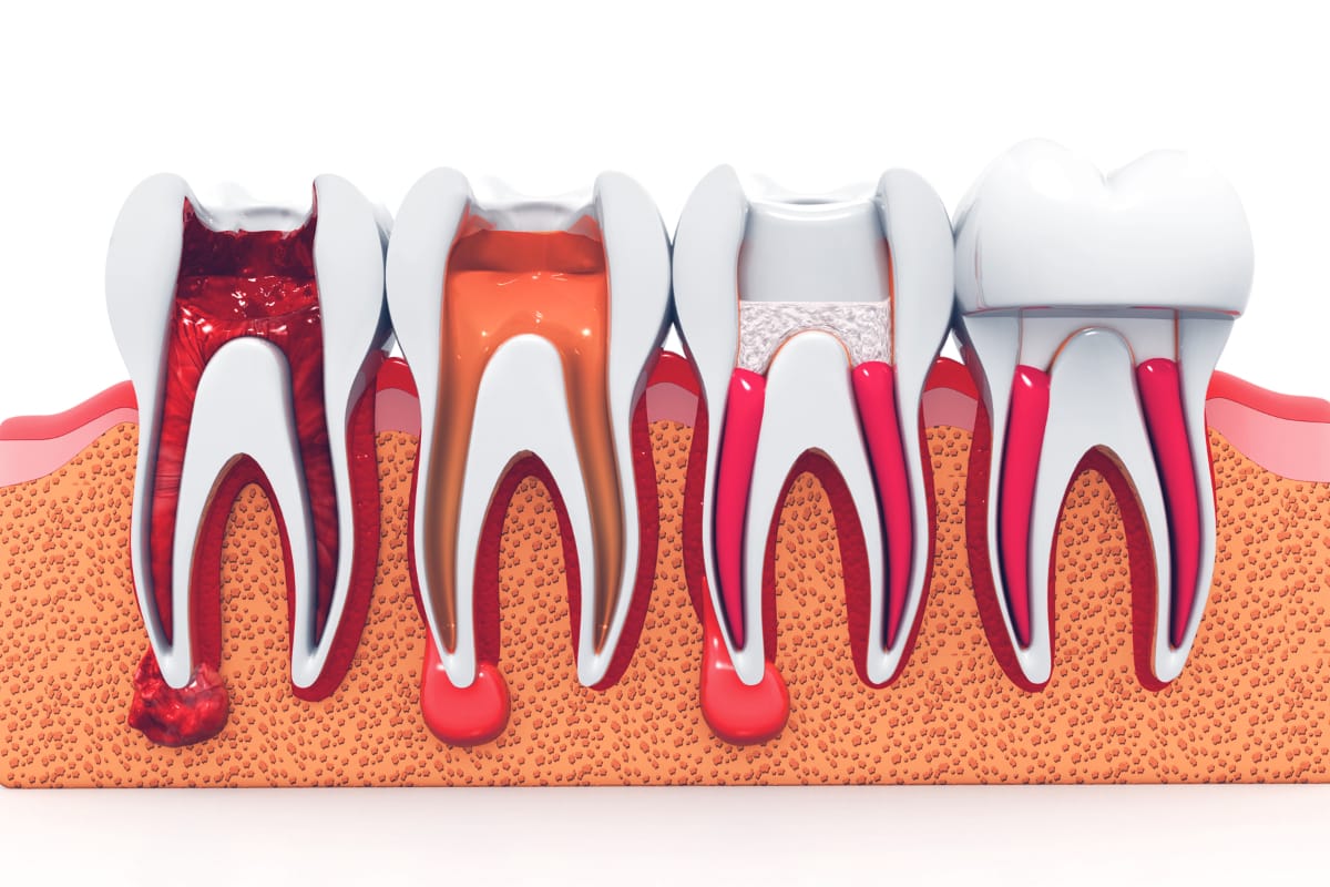 Endodoncia Como Realiza