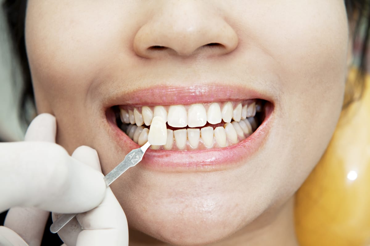 Estetica Dental Carillas