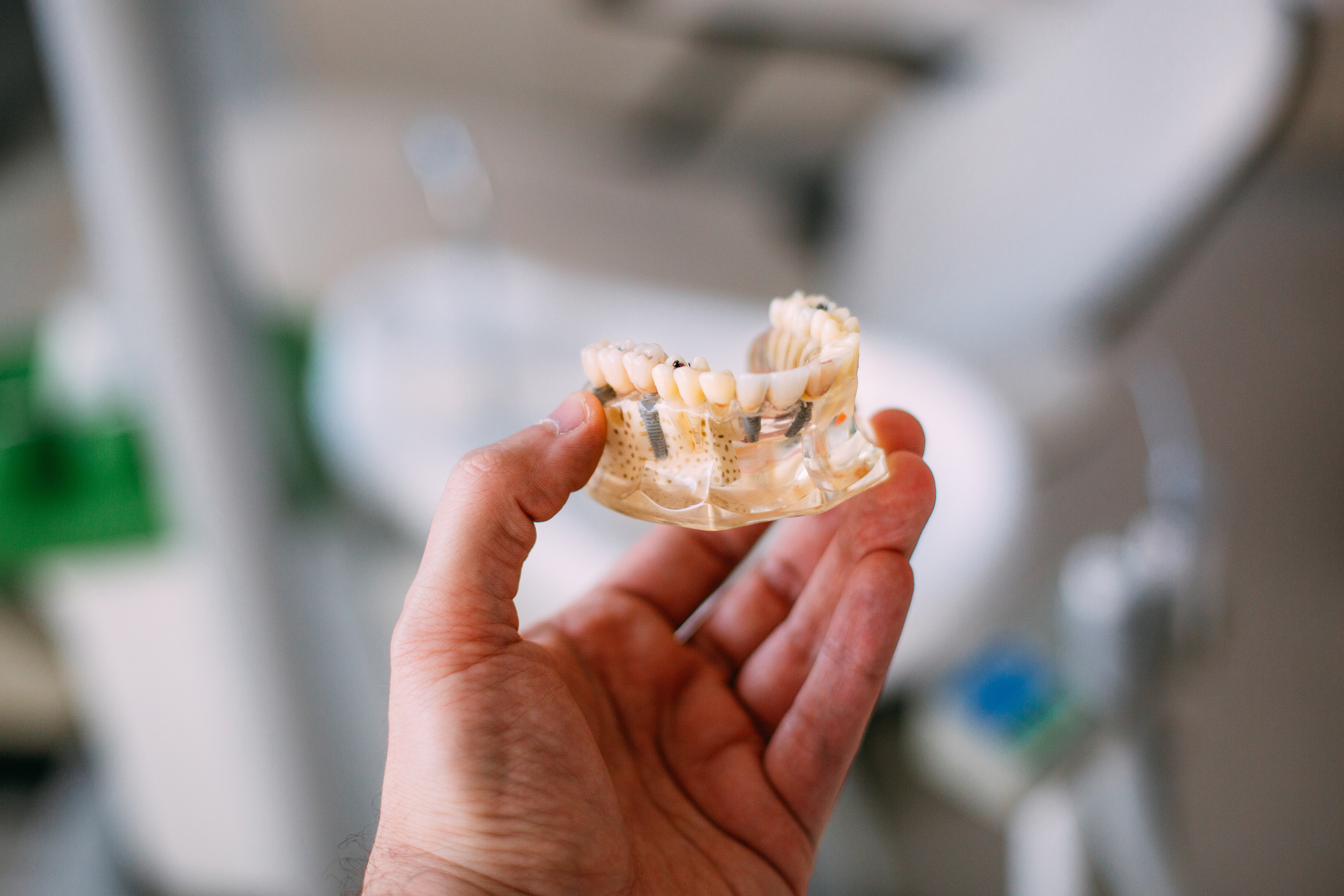 implantes dentales en Granada