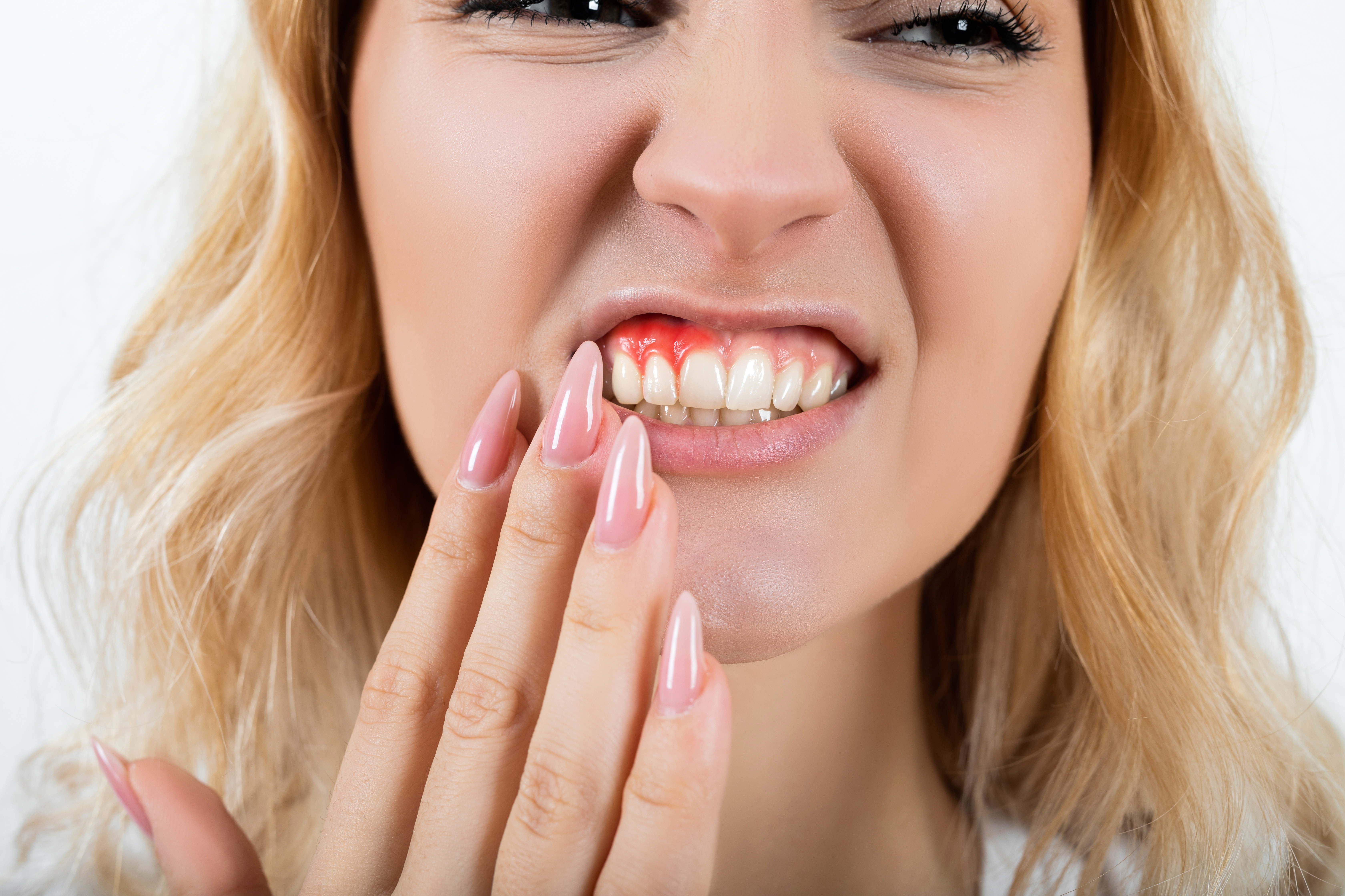 gingivitis