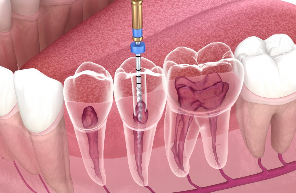 endodoncia