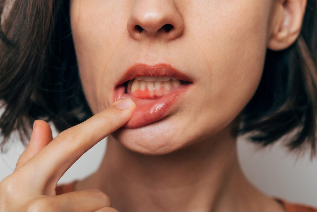 periodontitis