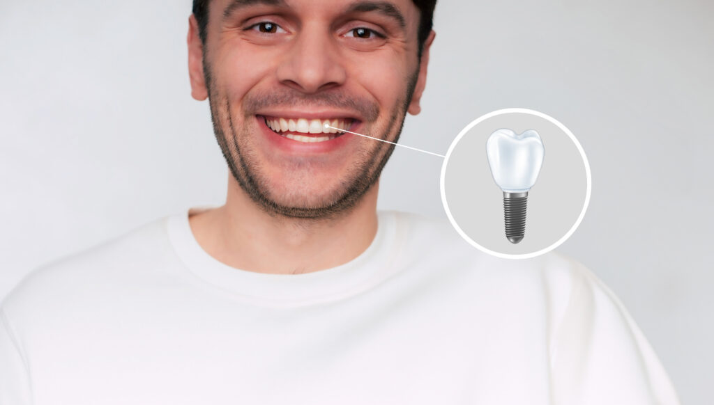 IMPLANTES DENTALES en Granada