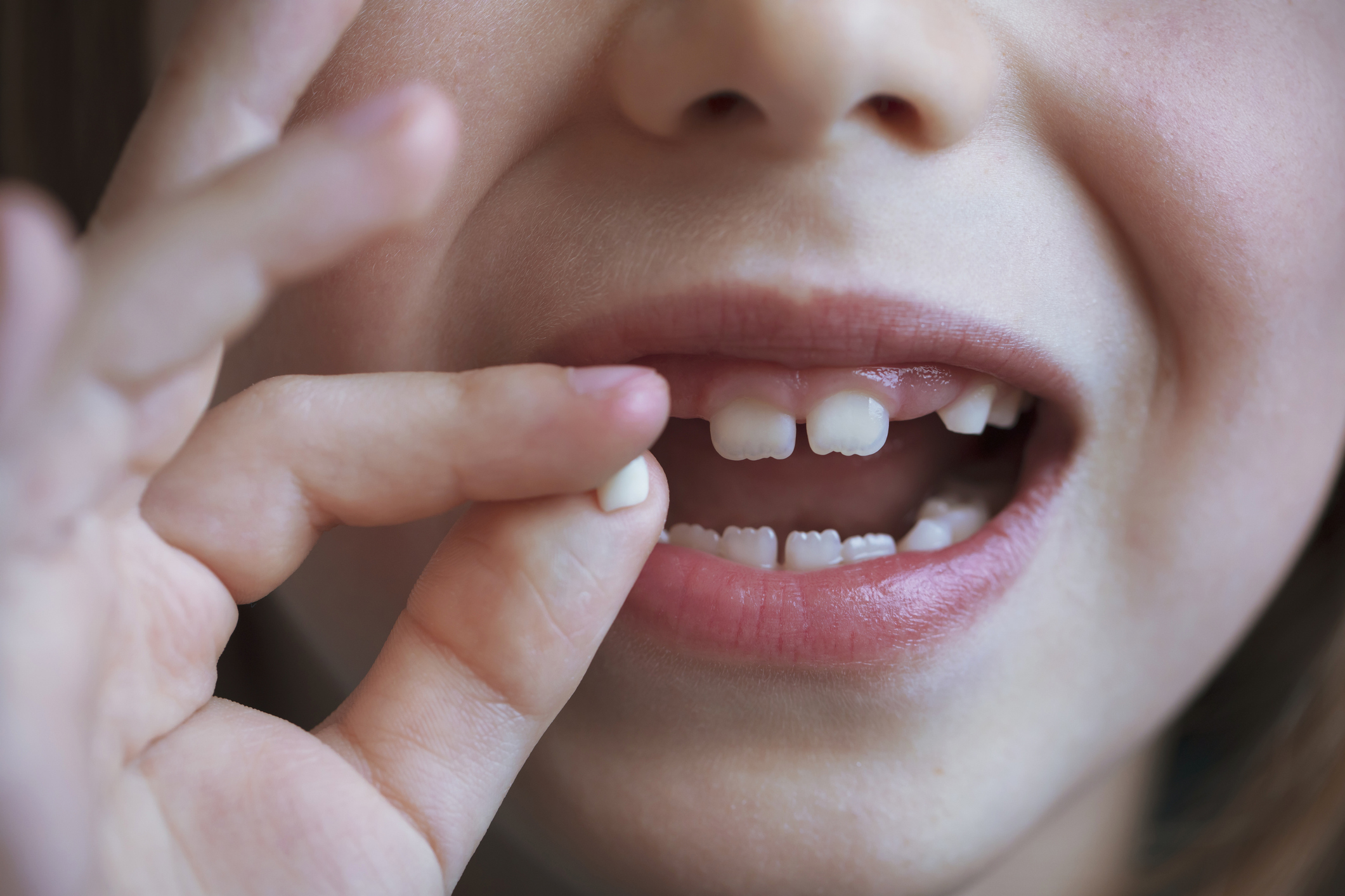 agenesia dental