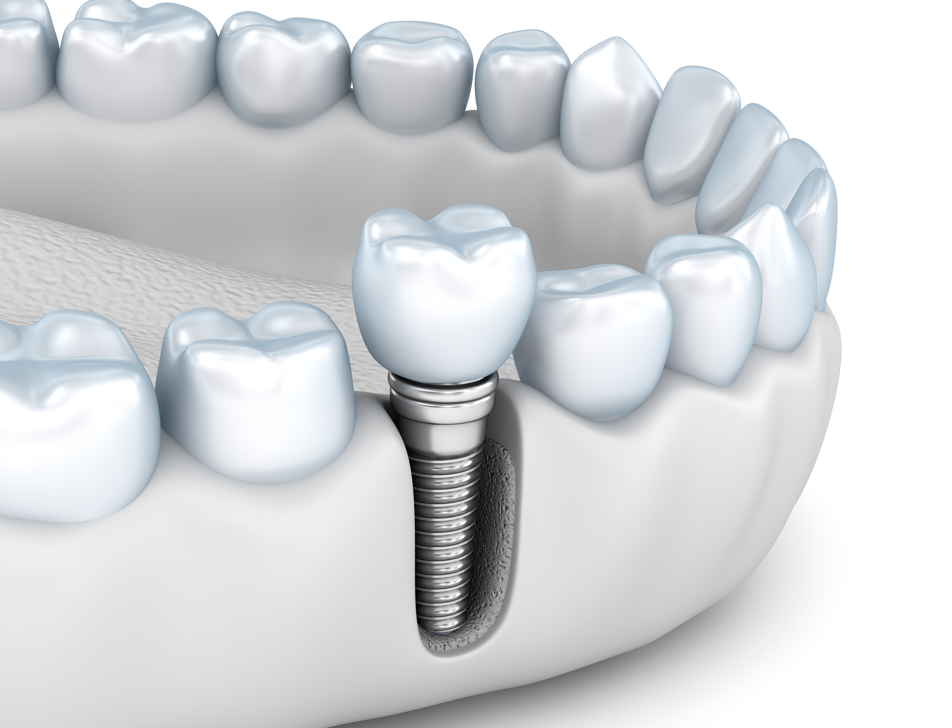 implantes dentales en Granada
