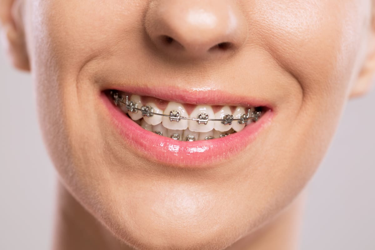 Ortodoncia Brackets Metalicos