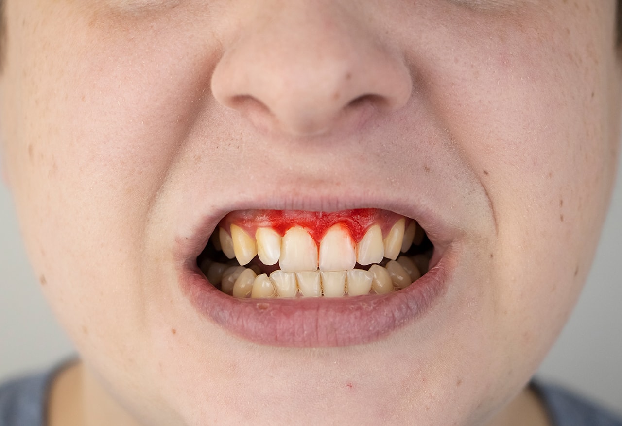 Periodoncia Sangrado