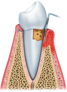 Periodoncia03