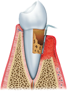 Periodoncia04